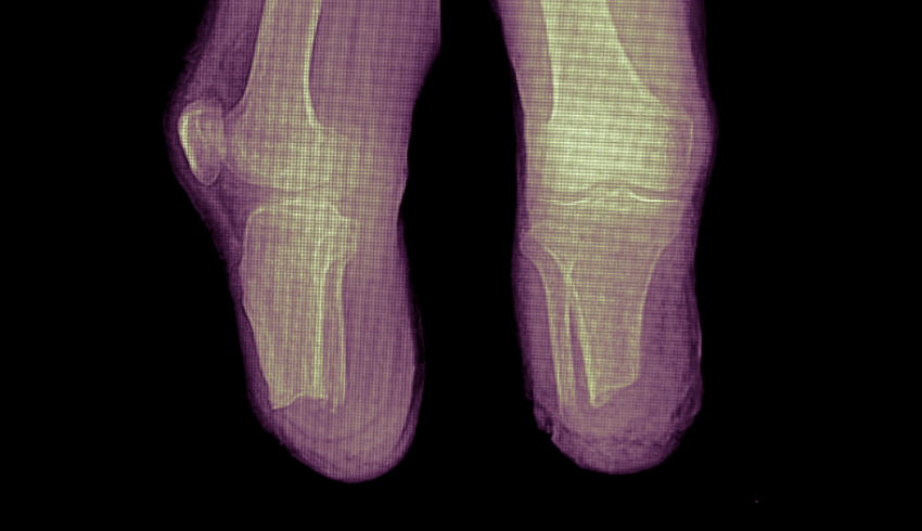 Röntgenkuva miinan vammauttamasta ihmisestä, jonka jalat katkeavat säären puolestavälistä.